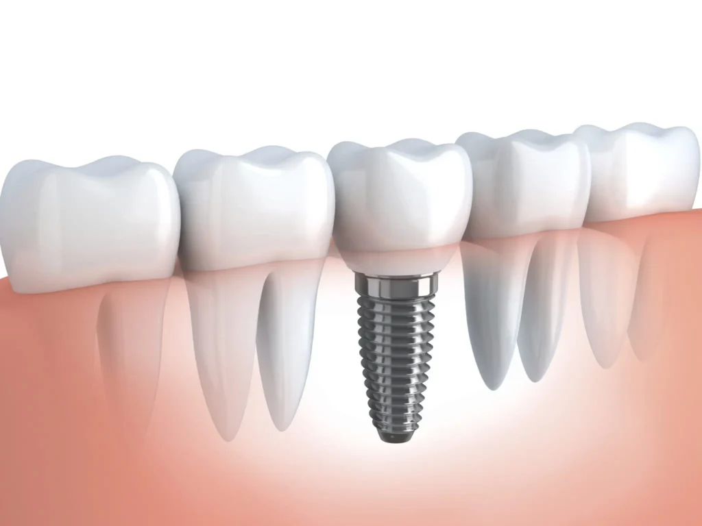 implante dentário em betim